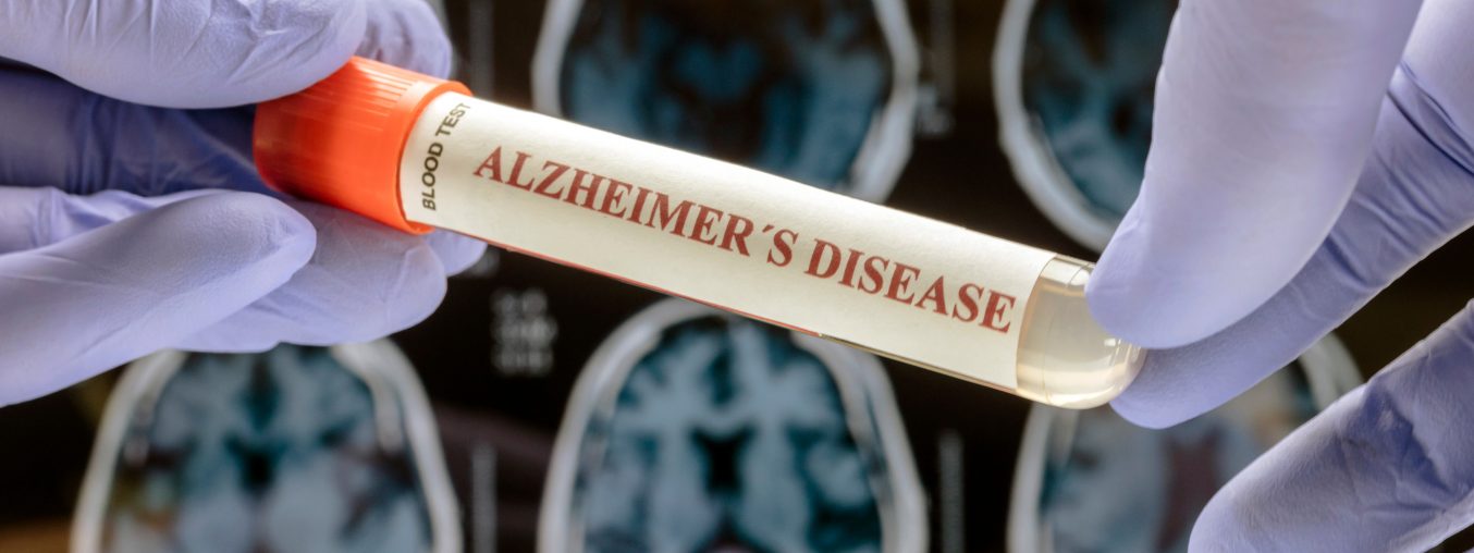 Alzheimer’s Disease: The Result of the Brain Trying to Protect Itself