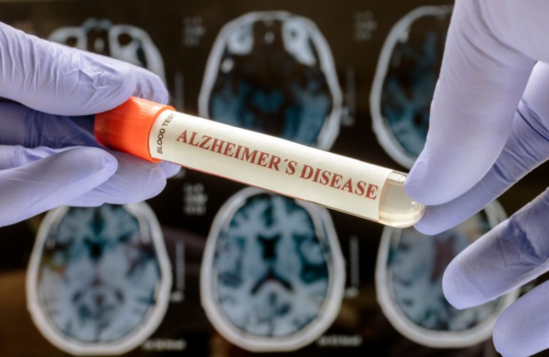 Alzheimer’s Disease: The Result of the Brain Trying to Protect Itself